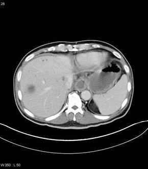 Abdominal CT showing massive hepatocellular carcinoma. Case courtesy of Dr Natalie Yang,[5]