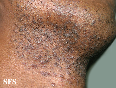 Pseudofolliculitis barbae. With permission from Dermatology Atlas.[1]