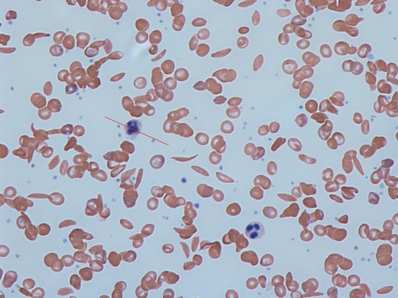 File:Sickle cells.jpg