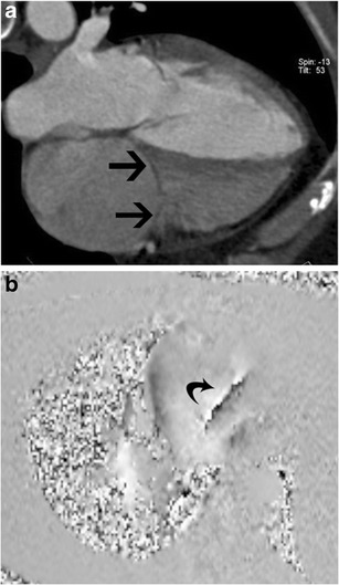 File:Tricuspid stenosis in CT and MRI.jpg
