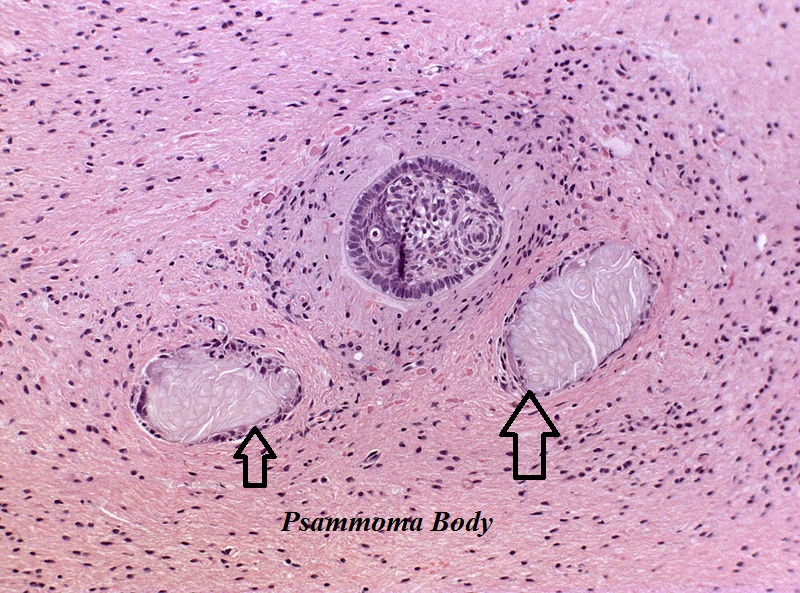 Craniopharyngioma; with psammoma bodies - by Jensflorian source: Librepathology