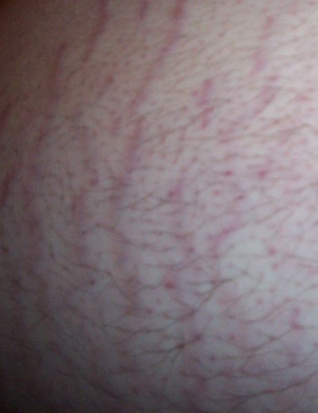 Belly Strech Marks.jpg