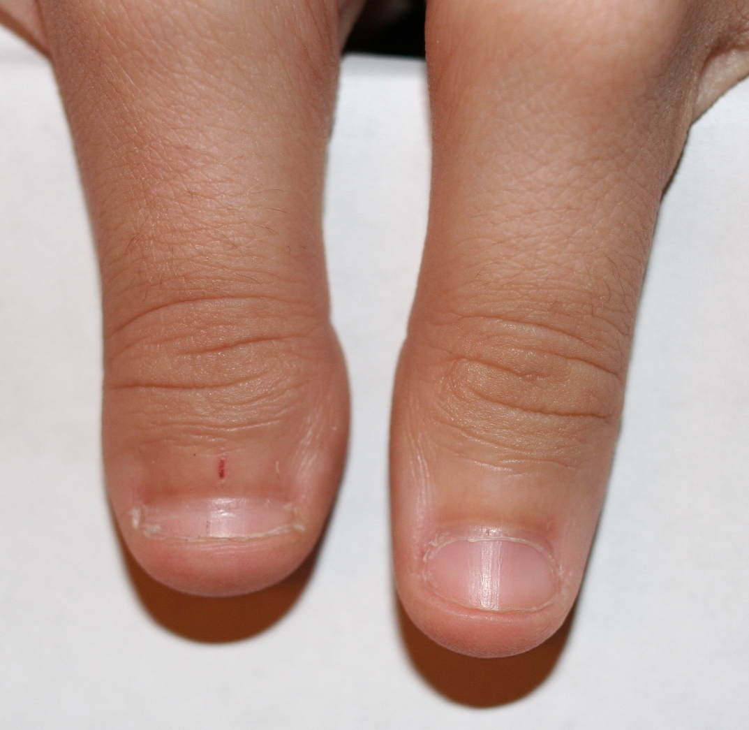 File:Clubbed Thumb 1.JPG