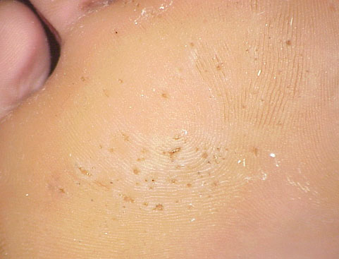 Pitted keratolysis. With permission from Dermatology Atlas.[2]