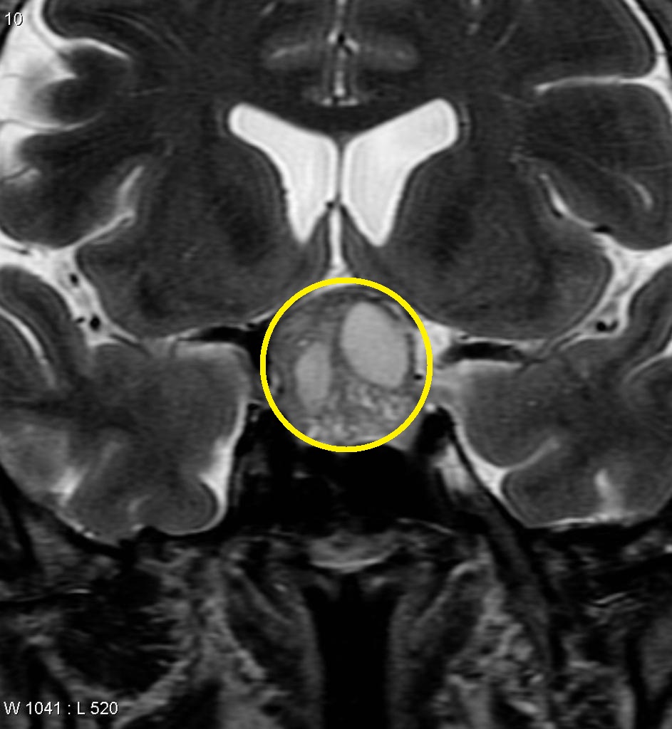 Pituitary non-functioning macroadenoma - Case courtesy of A.Prof Frank Gaillard, via Radiopaedia.org[1]