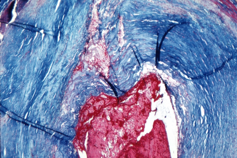 Right coronary artery: Atherosclerosis Plaque Ruptured with Thrombus: Micro low mag trichrome.