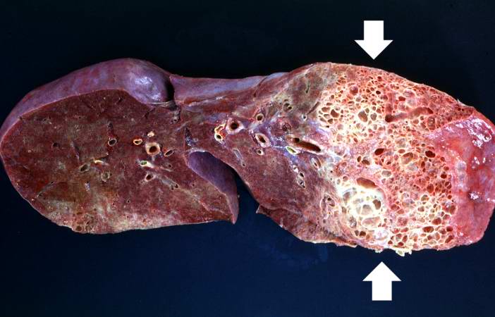 This is a gross photograph of a cut section of one lung from this patient. Note the extensive fibrosis lower lobe (arrows).