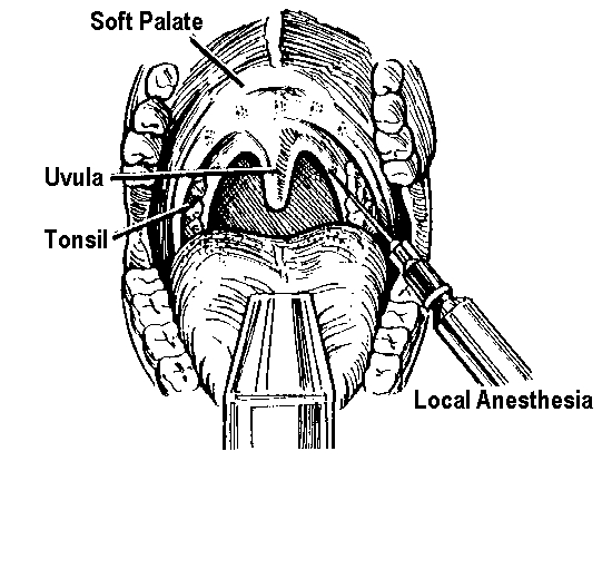 Uvulopalatopharyngoplasty Wikidoc