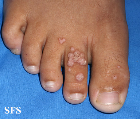 Warts vulgaris. Adapted from Dermatology Atlas.[1]