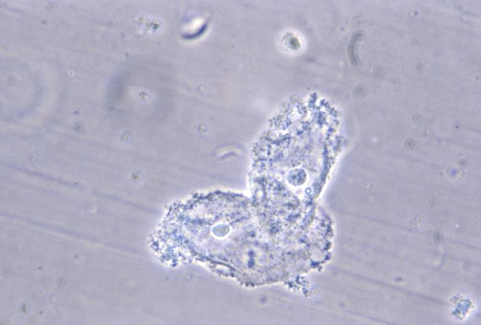 File:Bacterial vaginosis04.jpeg
