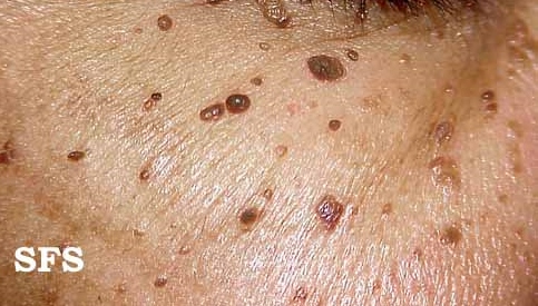 Dermatosis papulosa nigra. Adapted from Dermatology Atlas.[1]
