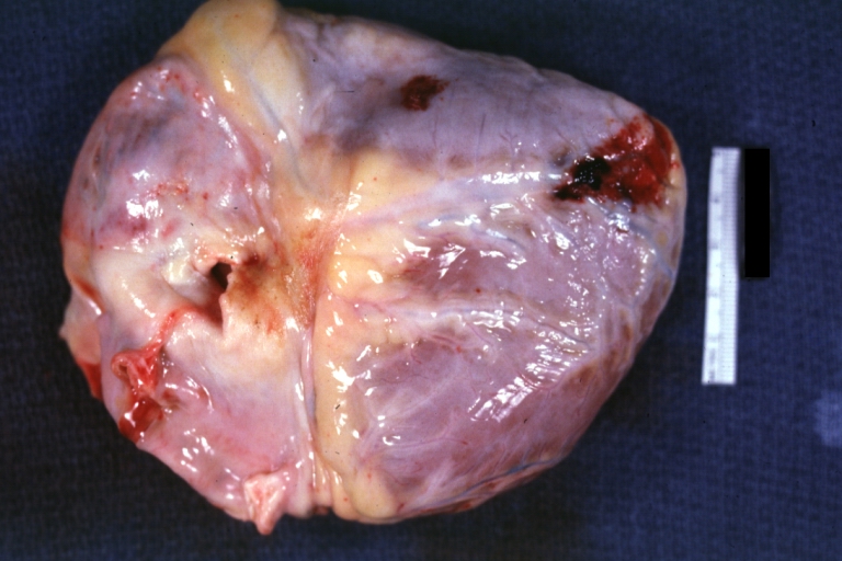 Hemopericardium: Hemopericardium caused by pericardiocentesis: Gross, natural color, view of apex of the heart. Needle apparently entered the distal posterior descending artery