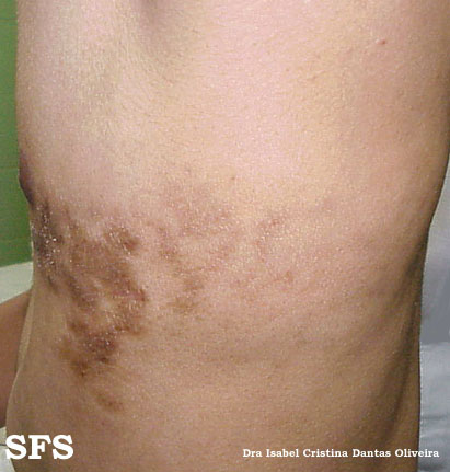Linear scleroderma. Adapted from Dermatology Atlas.[1]