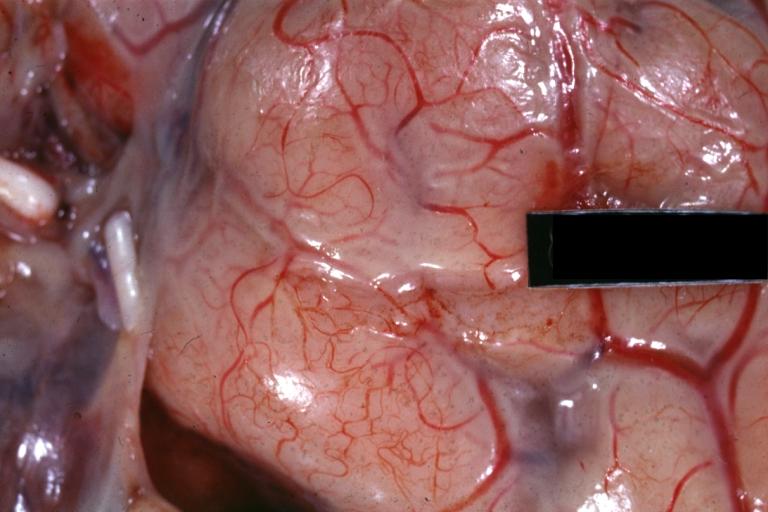Purulent Meningitis: Gross natural color close-up view outstanding example of purulent exudate adjacent to blood vessels