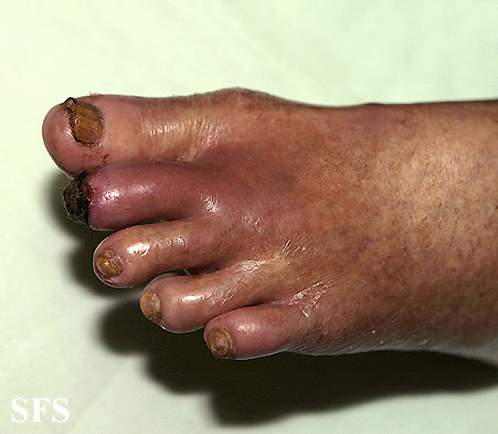 Peripheral occlusive arterial disease. With permission from Dermatology Atlas.[1]