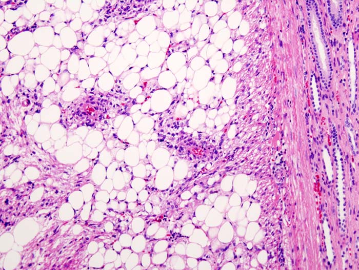 Histopathologic slide of renal angiomyolipoma. Nephrectomy specimen. H & E stain.[7]