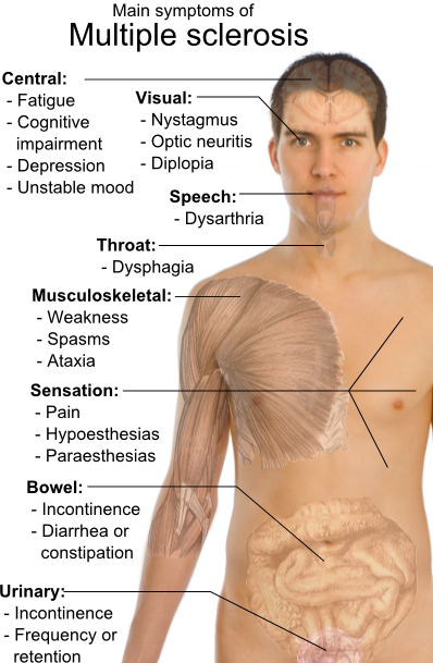 Main symptoms of multiple sclerosis.