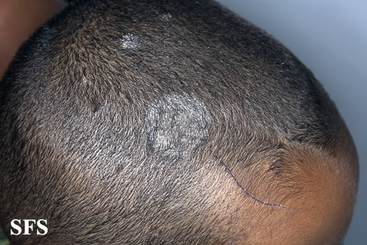 Tinea capitis. Adapted from Dermatology Atlas.[10]