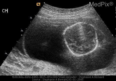 File:Ultrasound Cystic Hygroma with hydrops fetalis Turner Syndrome.jpg