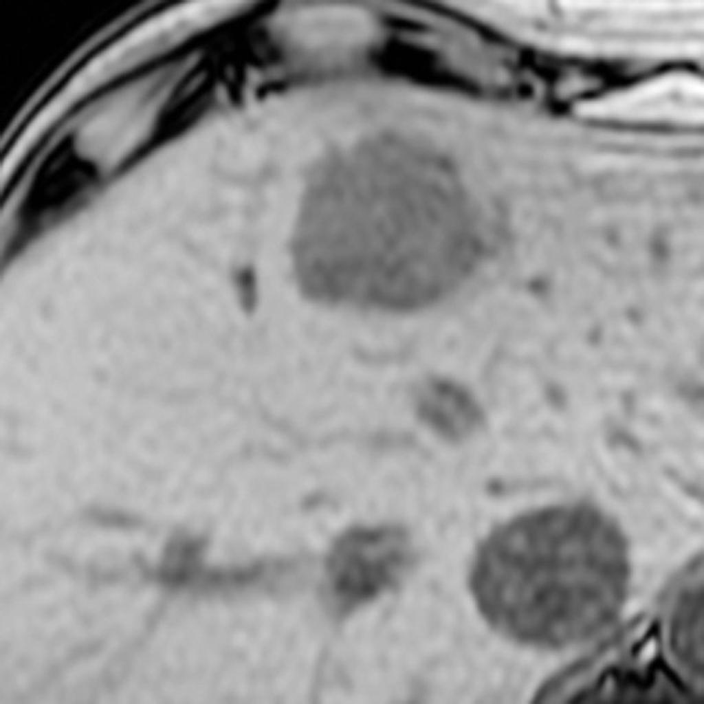 Selected images from liver MRI show a large, subtle T2 hyperintense, well defined rounded lesion in the liver which demonstrates homogenous signal loss on T1 opposed phase scans. Post contrast images, there is prompt arterial enhancement and lesional washout. Incidental lesion lateral to the main one is seen, best appreciated on the arterial phase.