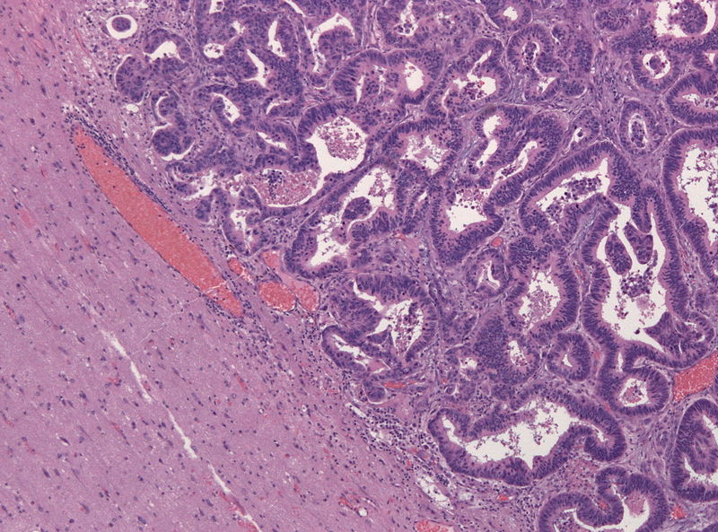 Adenocarcinoma infiltrating the brain in a case of lung cancer on H&E stain.[4]