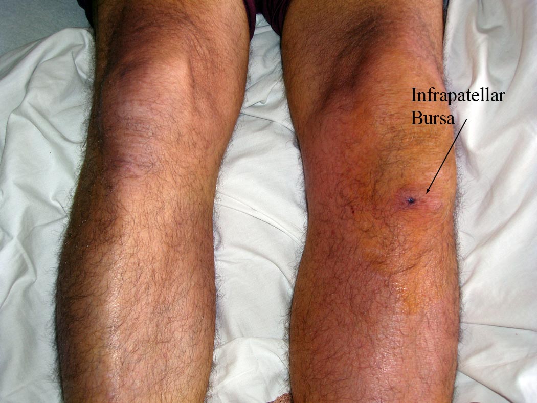 Infrapatellar Bursitis: Redness and swelling of left infrapatellar bursa.