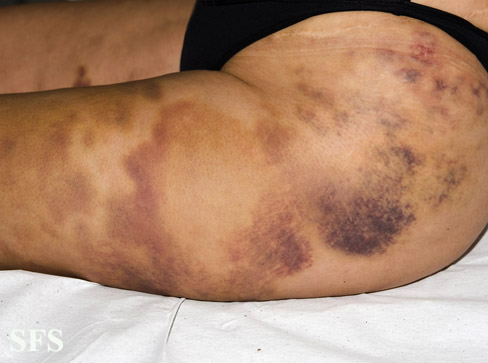 File:Painful bruising syndrome03.jpg