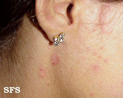 File:Seborrhoeic dermatitis 08.jpeg