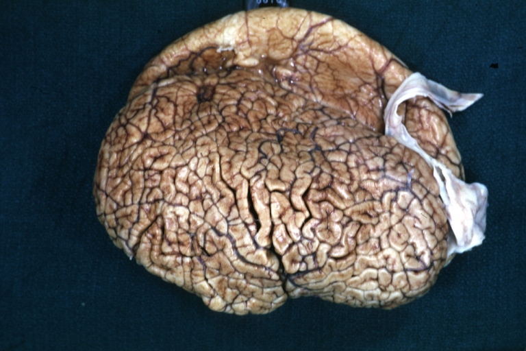 Brain: Polymicrogyria: Gross fixed brain lateral view of left cerebral hemisphere case of Arnold Chiari cerebellum