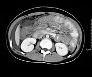 Spiral CT showing ascites and concentric thickening of colon and ileum in eosinophilic gastroenteritis