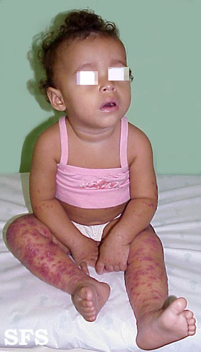 File:Eczema herpeticum01.jpg