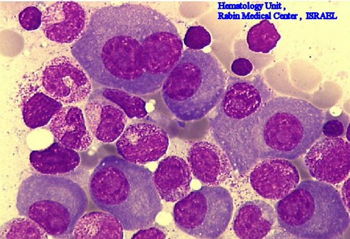 Multiple Myeloma slide showing plasma cells with large nucleus and scant cytoplasm [10]