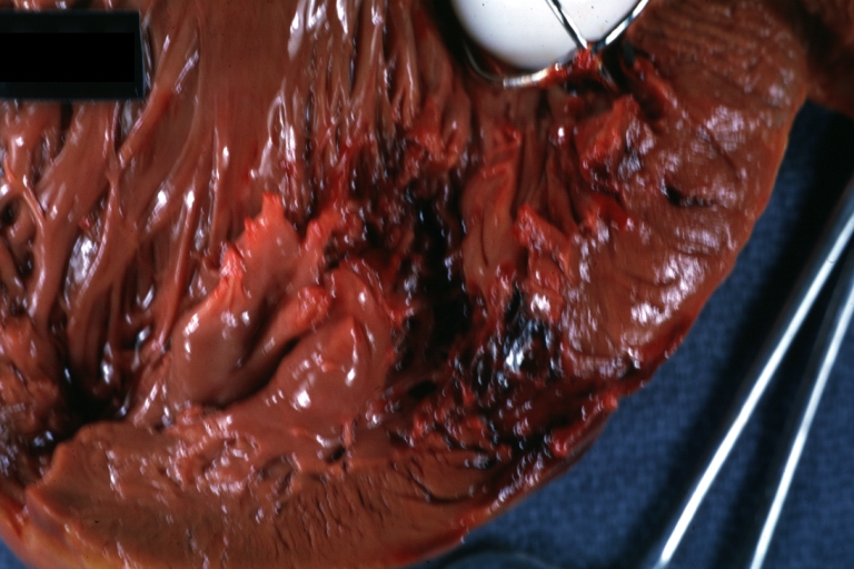 HEART: Myocardial Rupture Following Mitral Valve Replacement: Gross, natural color portion of caged plastic ball prosthesis shown with close-up of ruptured left ventricular wall