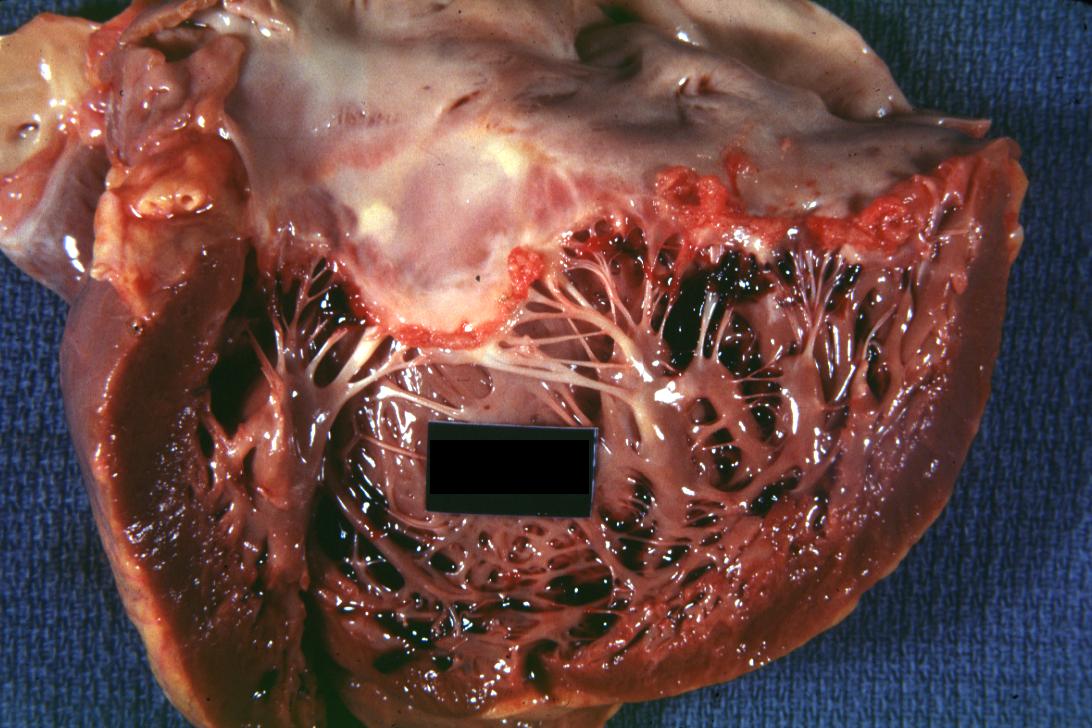 Thrombotic Nonbacterial Endocarditis: (Gross) Mitral valve: an excellent image, identical to acute rheumatic lesion