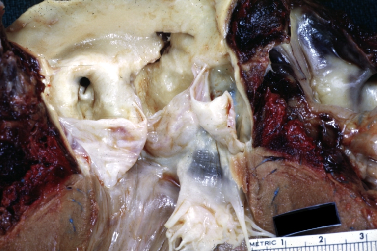 Dissecting Aneurysm: Gross, aortic valve area dissection (well shown, typical lesion)