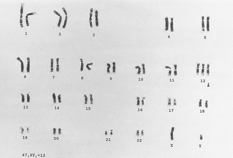 B-cell chronic lymphocytic leukemia: Trisomy for chromosome 12 Karyotype of a lymphocyte from a patient with B CLL showing an extra copy of chromosome 12. (G-banded, Wright-Giemsa stained)