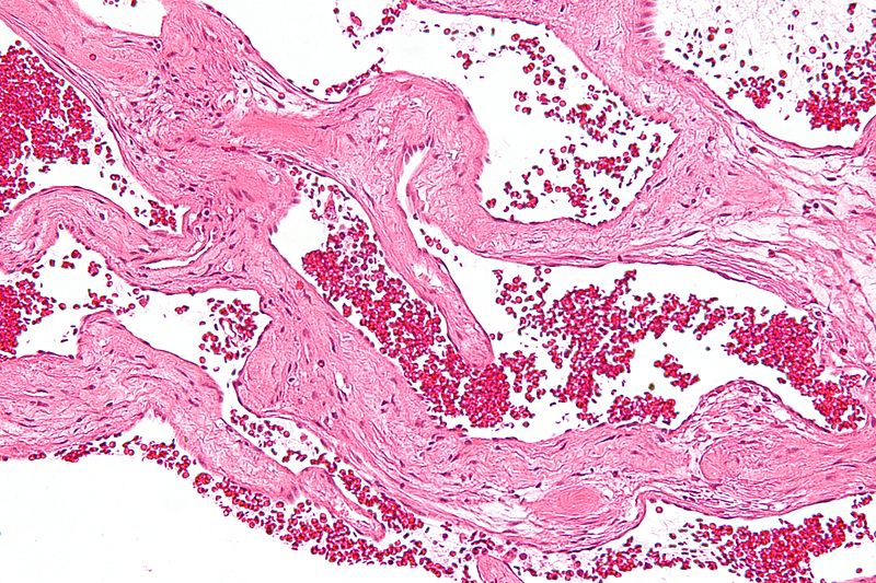 High magnification micrograph of a cavernous hemangioma of the liver, also hepatic cavernous hemangioma, liver hemangioma,cavernous liver hemangioma. H&E stain. No liver tissue is observed.[4]