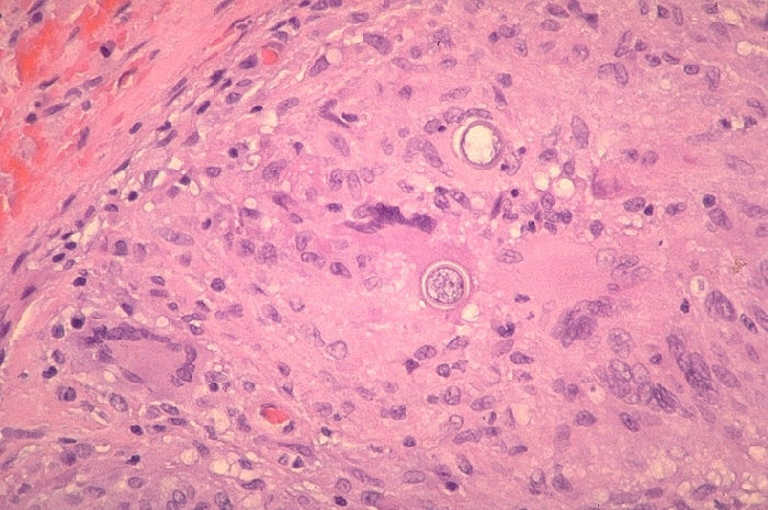 Histopathology of coccidioidomycosis, retroperitoneal area. From Public Health Image Library (PHIL). [5]