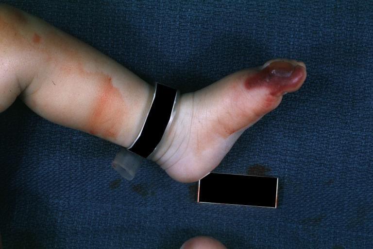 Congenital aortic stenosis: Gangrene toe In Infant: Gross, natural color, 1-month-old child with congenital aortic stenosis