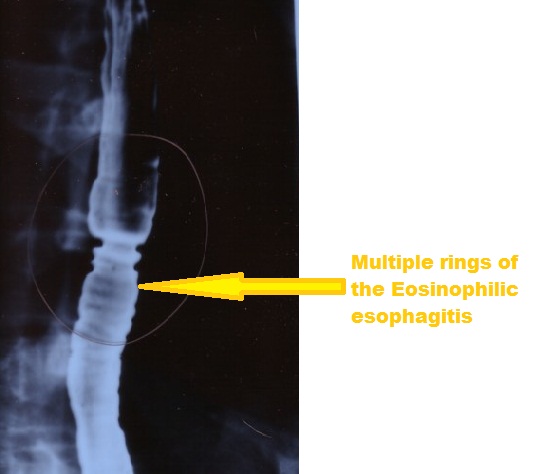 File:Eosinophilic esophagitis-barium swallow.jpg