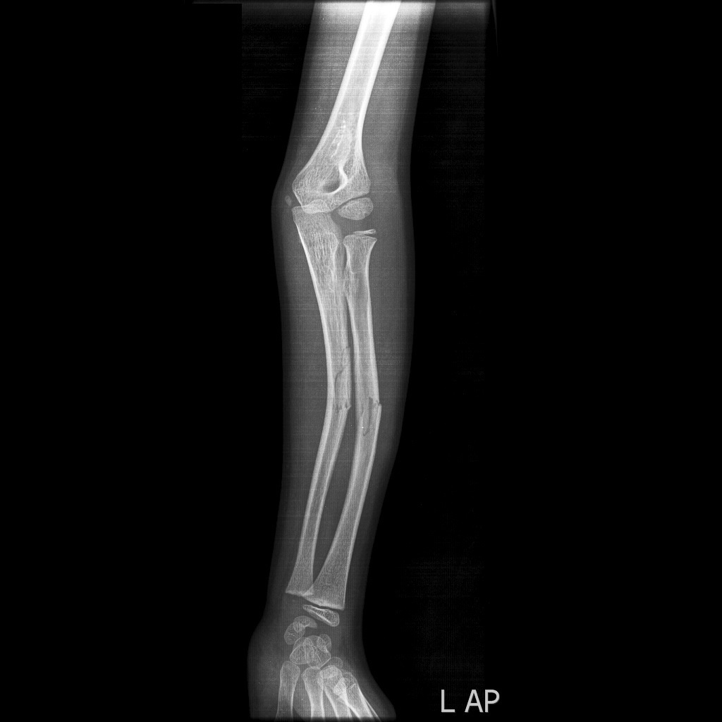 Radius and ulna greenstick fractures - AP view