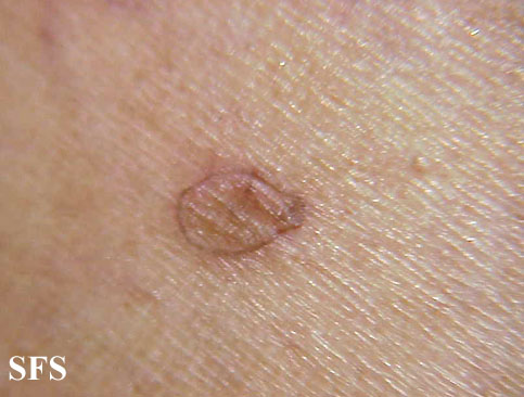 Porokeratosis actinic. With permission from Dermatology Atlas.[5]