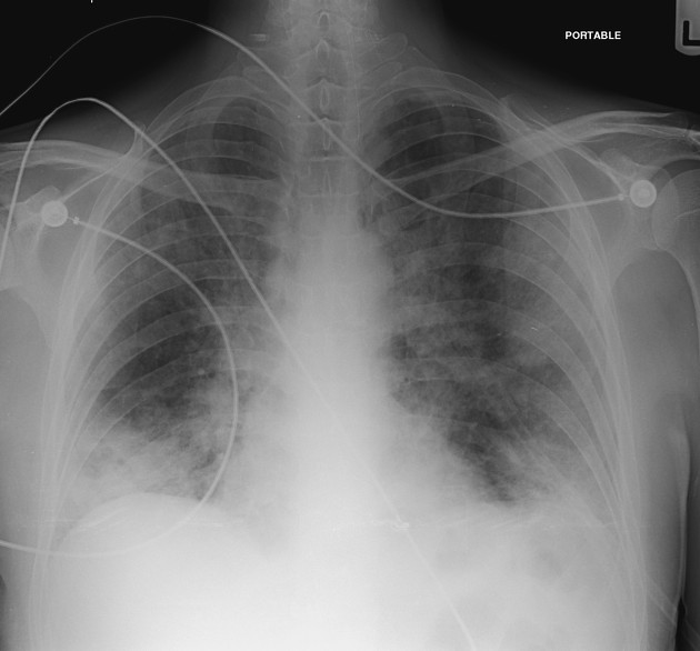 File:Acute Interstitial Pneumonitis Chest Xray - Case Courtesy of Dr Salam, Radiopaedia, rID 45404.jpeg