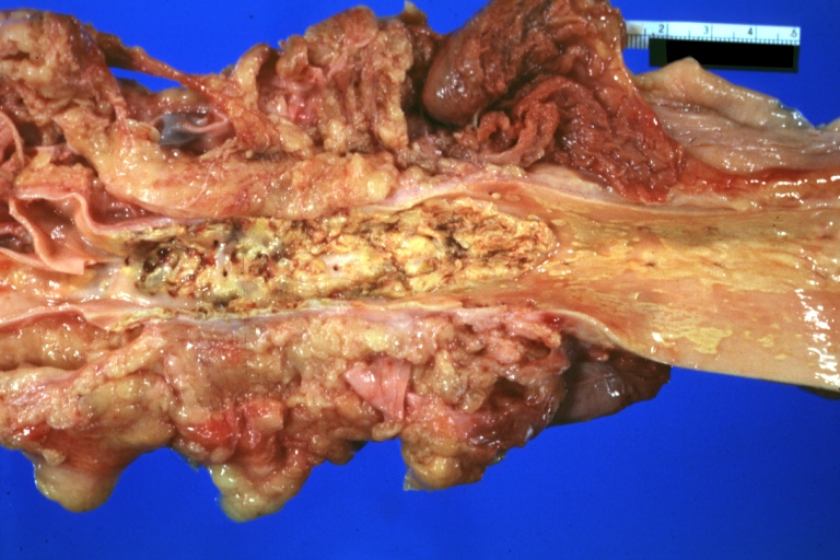 Atherosclerosis: Renal Transplant: Gross, natural color, a close-up view of severe atherosclerosis in abdominal segment of aorta and fatty streaks in descending thoracic much advanced lesions for a 22 years old male with chronic glomerulonephritis