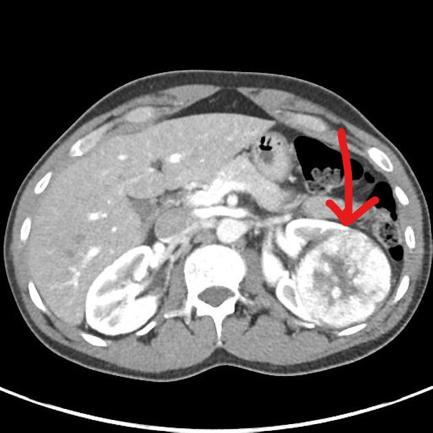 File:Axial contrast CT of renal oncocytoma.jpg