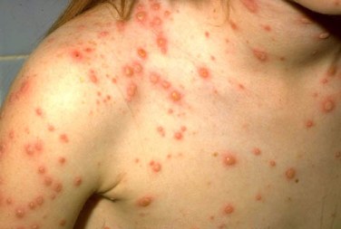 Chickenpox in unvaccinated child.
