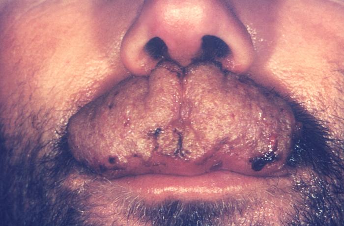 Close view of the lips and nose of a male patient infected with the dermatophytic fungus, Trichophyton mentagrophytes. From Public Health Image Library (PHIL). [6]