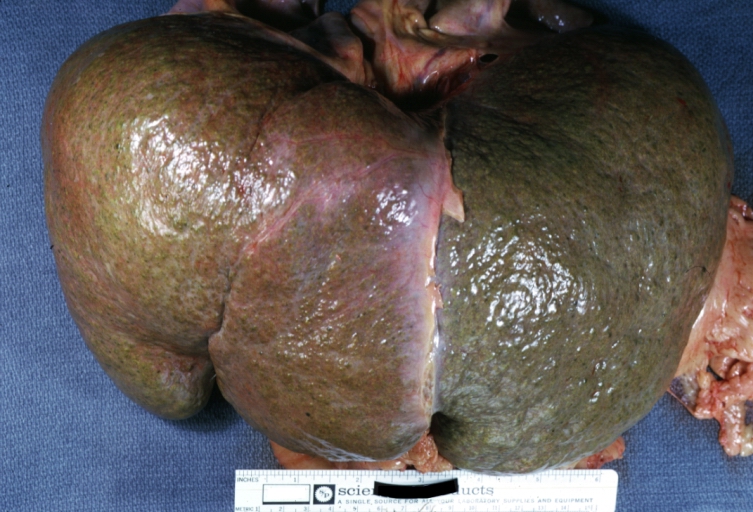 Micronodular cirrhosis: Gross, natural color, view of whole liver showing external surface typical cirrhotic liver (history of alcoholism)