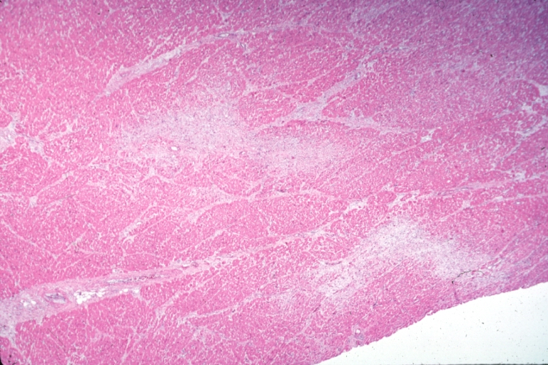 Heart: Cocaine dependence: Micro low mag scars in myocardium. Specimen taken from a woman in twenties after sudden death.