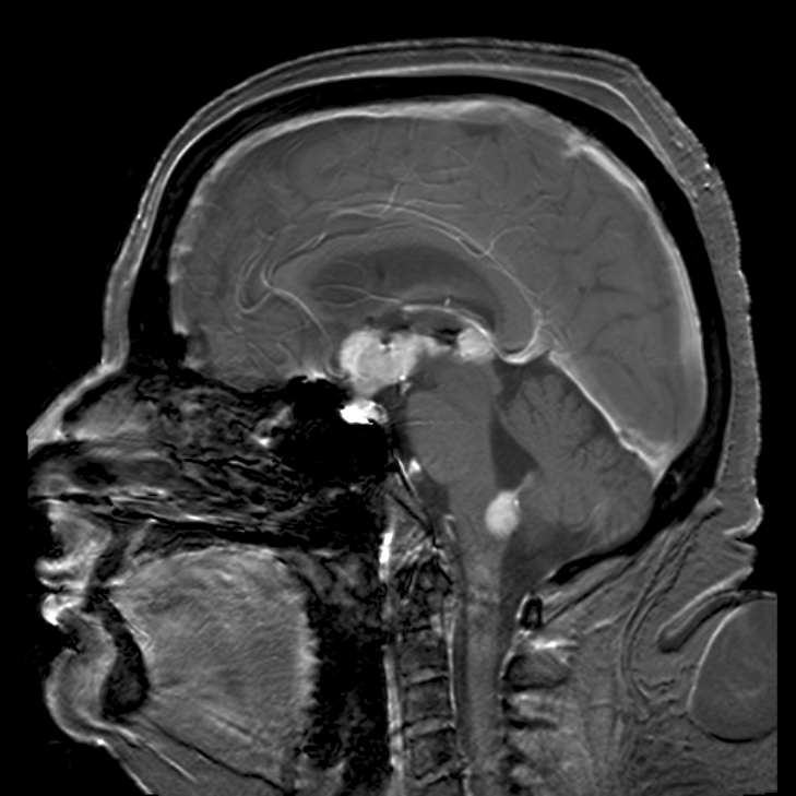 Brain magnetic resonance imaging demonstrating primary central nervous system B-cell non-Hodgkin lymphoma of the sella turcica and hypothalamus, continuing to the tectum (intensely white areas in the middle).[2]